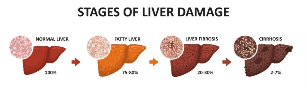liver damage stages
