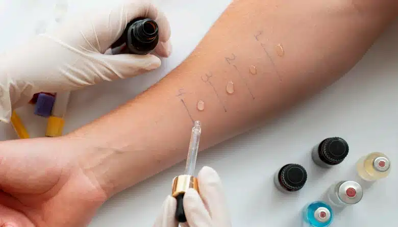 Skin Prick Test - Allergy Testing