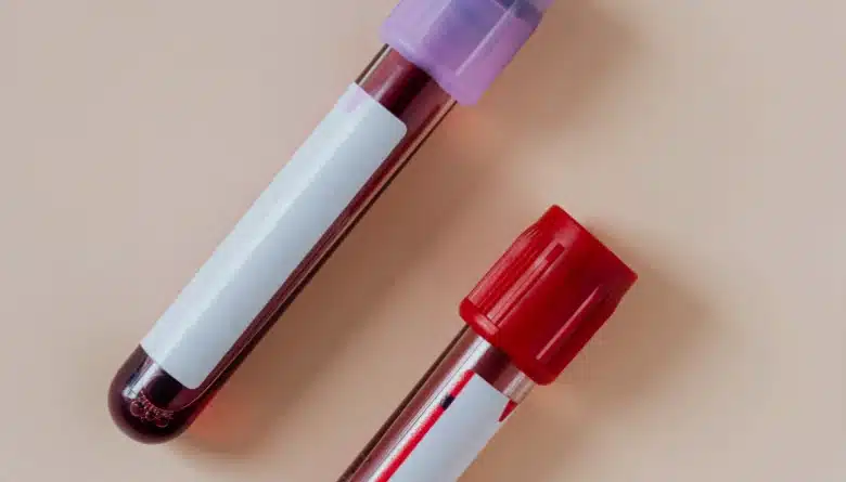 Blood Allergy RAST Test - Allergy Testing