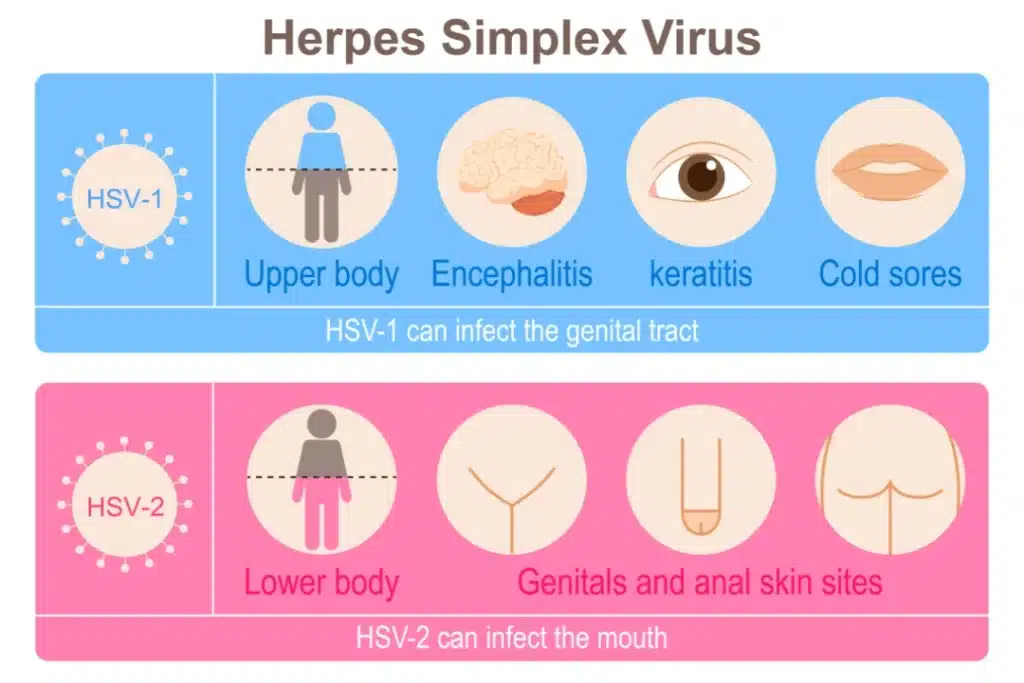 herpes simplex virus