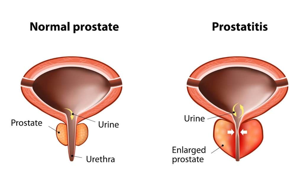 prostatitis