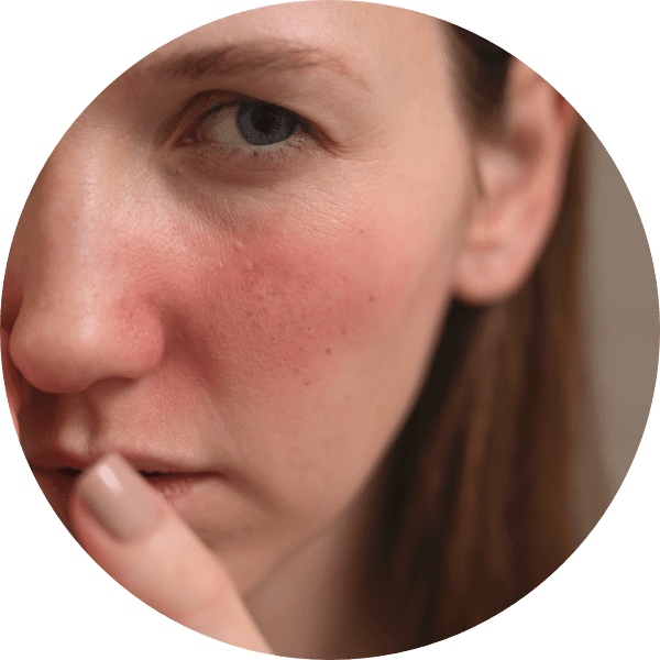Itchy red swelling in the Mouth, Lips or Eyes - Allergy Common Signs & Symptoms