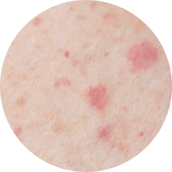 Rashes - Allergy Common Signs & Symptoms