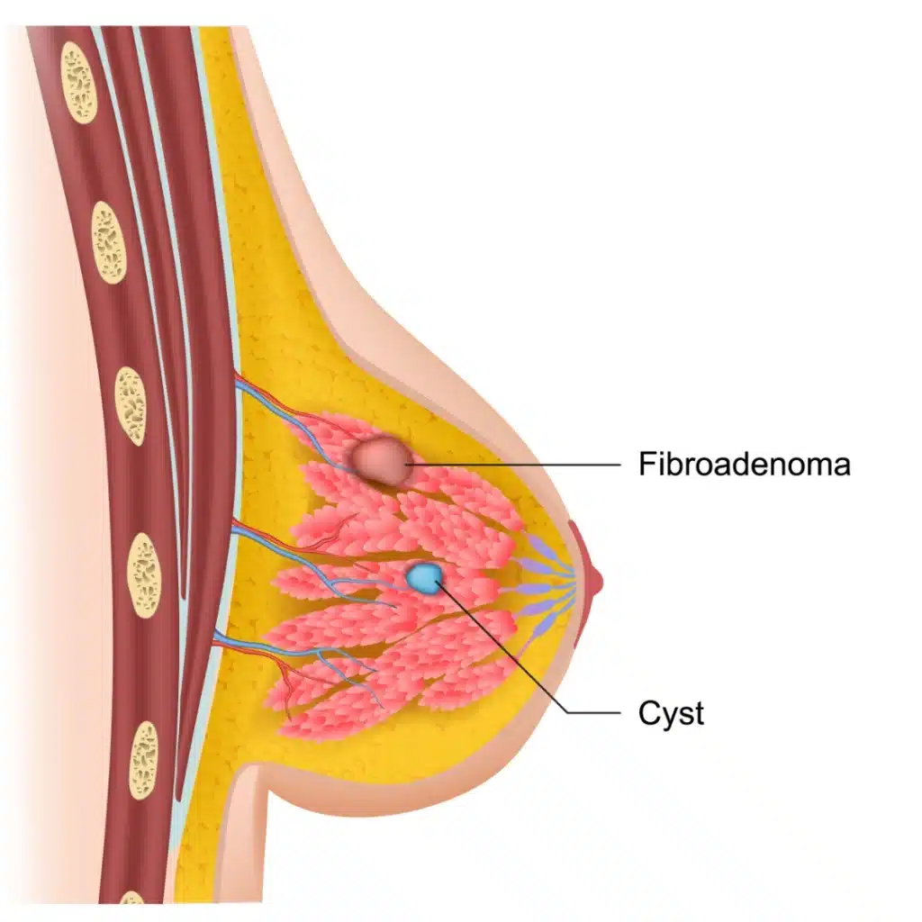 fibroadenoma and cysts