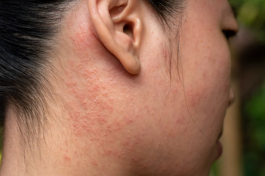 skin rash