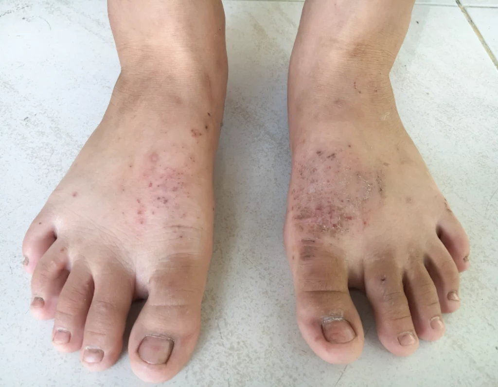 dermatitis on feet