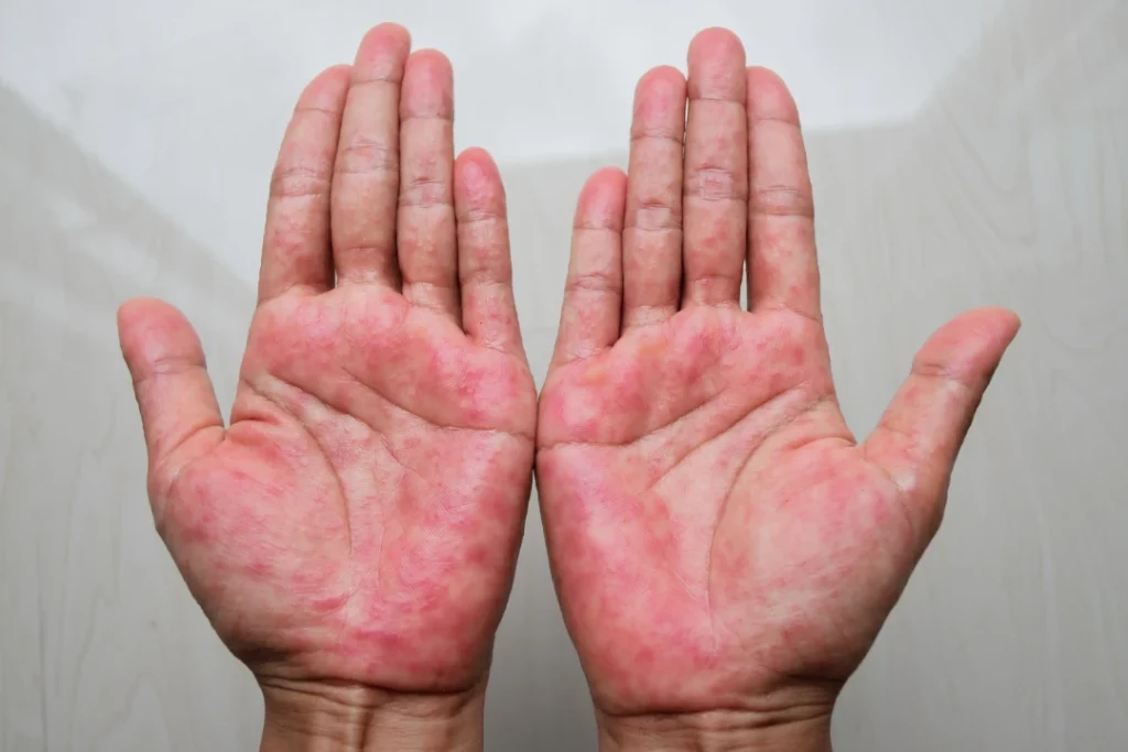 hand eczema