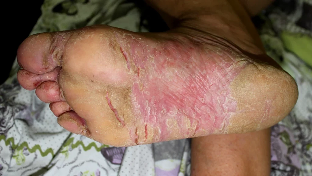 feet eczema