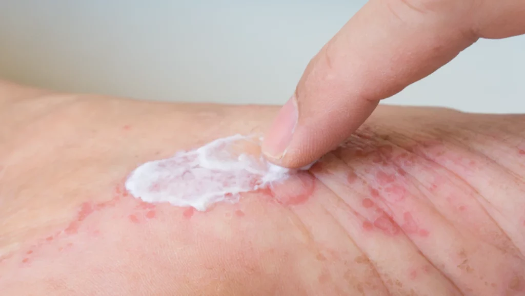 eczema steroids
