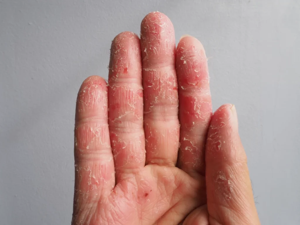 dyshidrotic eczema