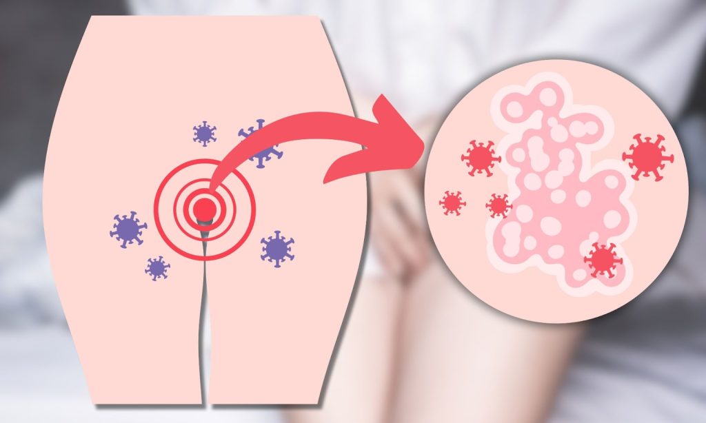 genital warts
