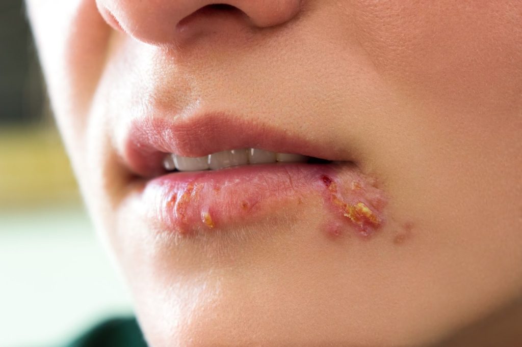herpes lips