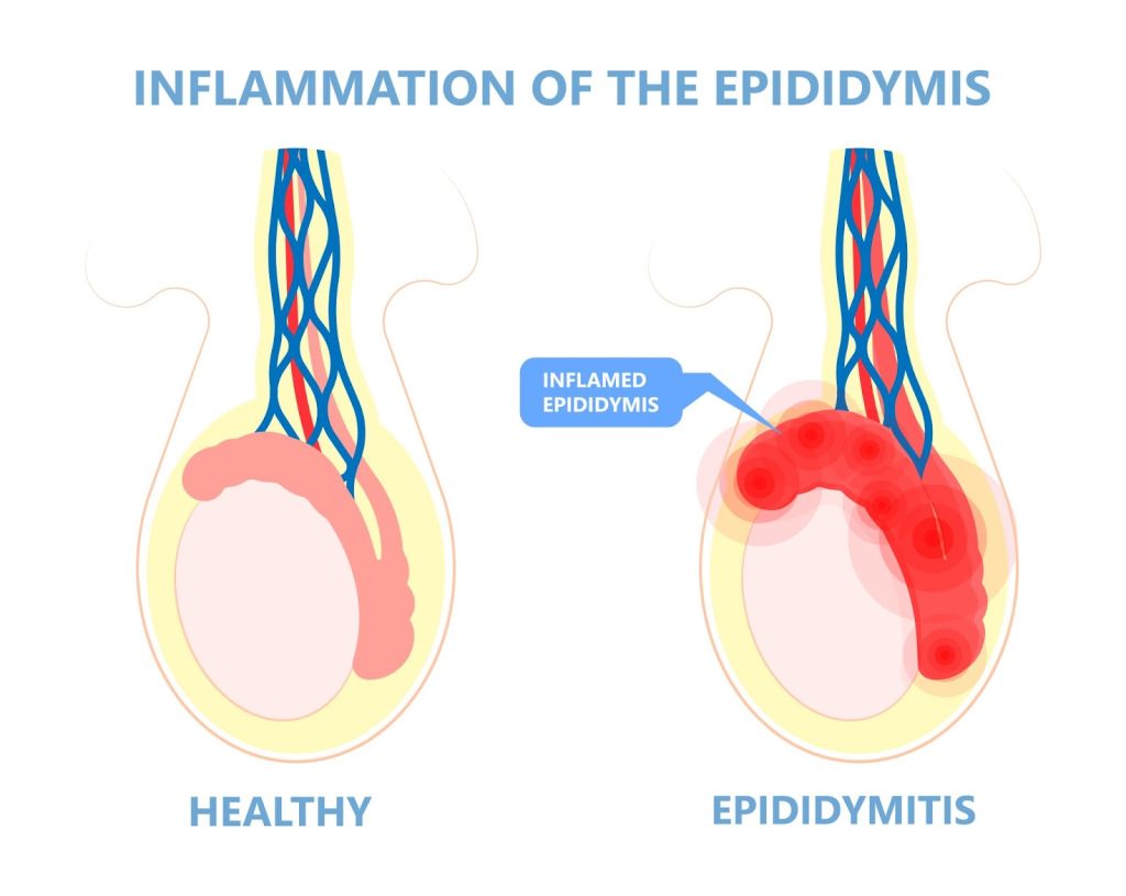 epidiymitis mgen