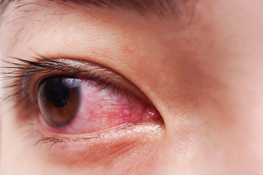 eye inflammation