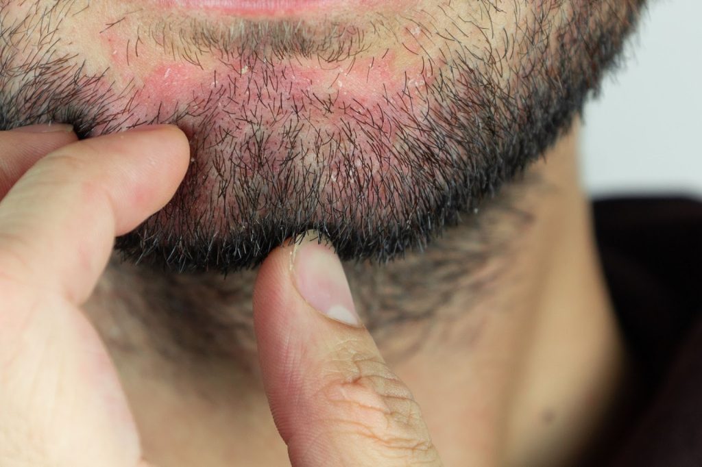 seborrheic dermatitis HIV