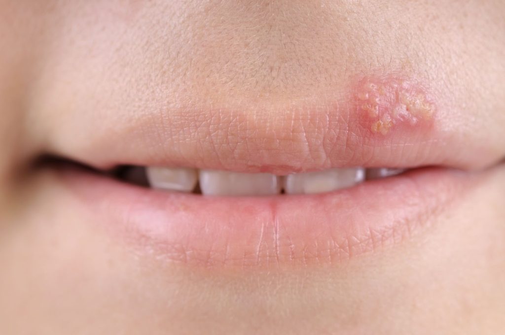 HSV infection lips