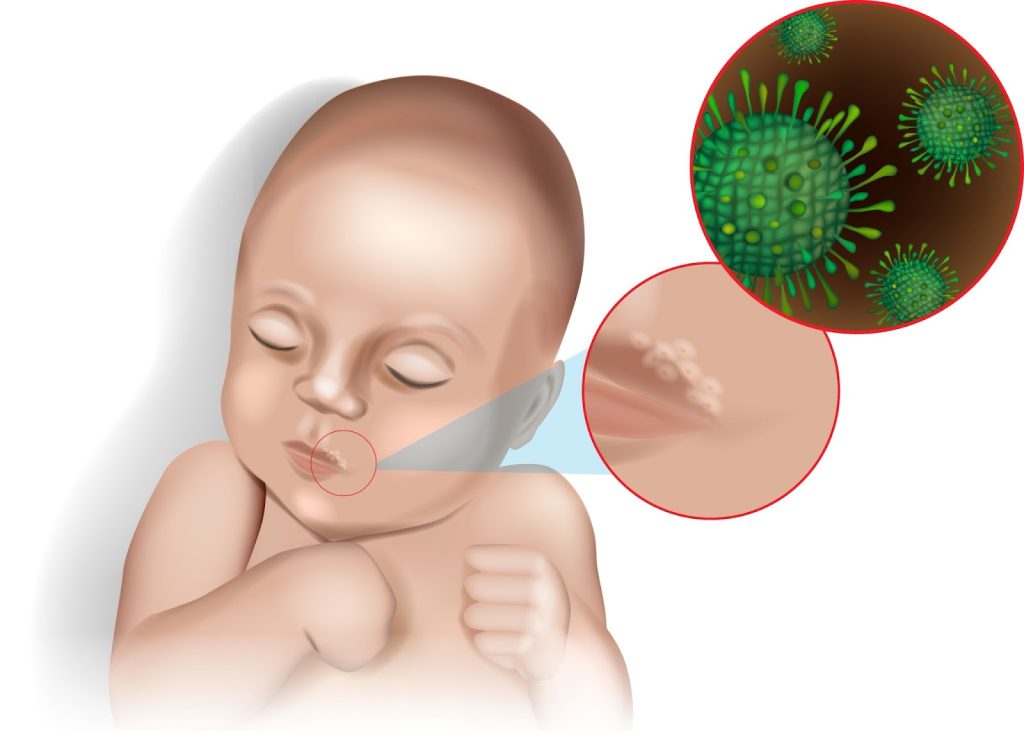 baby herpes