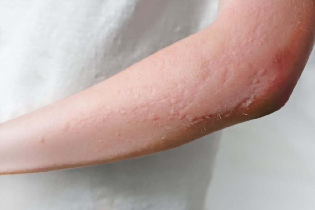 rashes hives