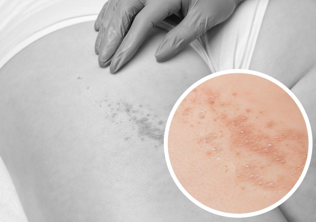 molluscum contagiosum singapore