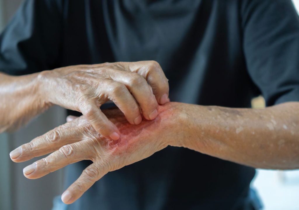 skin allergies in elderly singapore