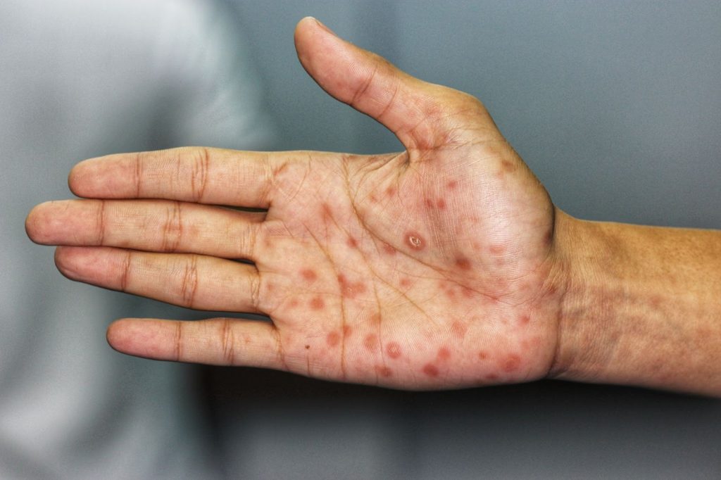 syphilis sores on hand singapore